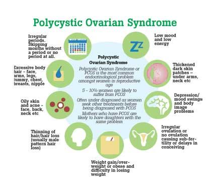 Daily Mirror Polycystic Ovarian Syndrome The Silent