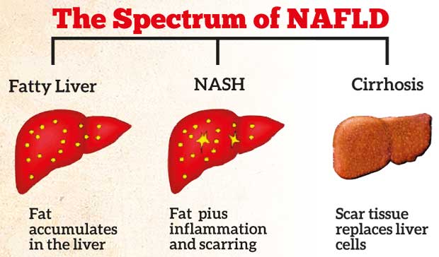 Diet Chart For Fatty Liver Grade 2